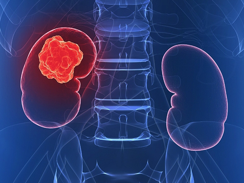 cancer renal si de rinichi